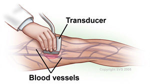 DVT Ultrasound