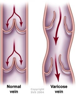 vein valves 2