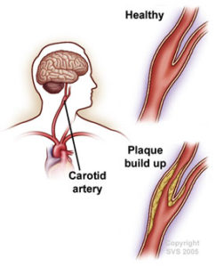 carotid artery disease