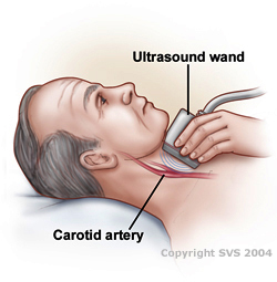 carotid us image