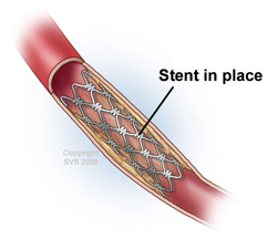 pad stent