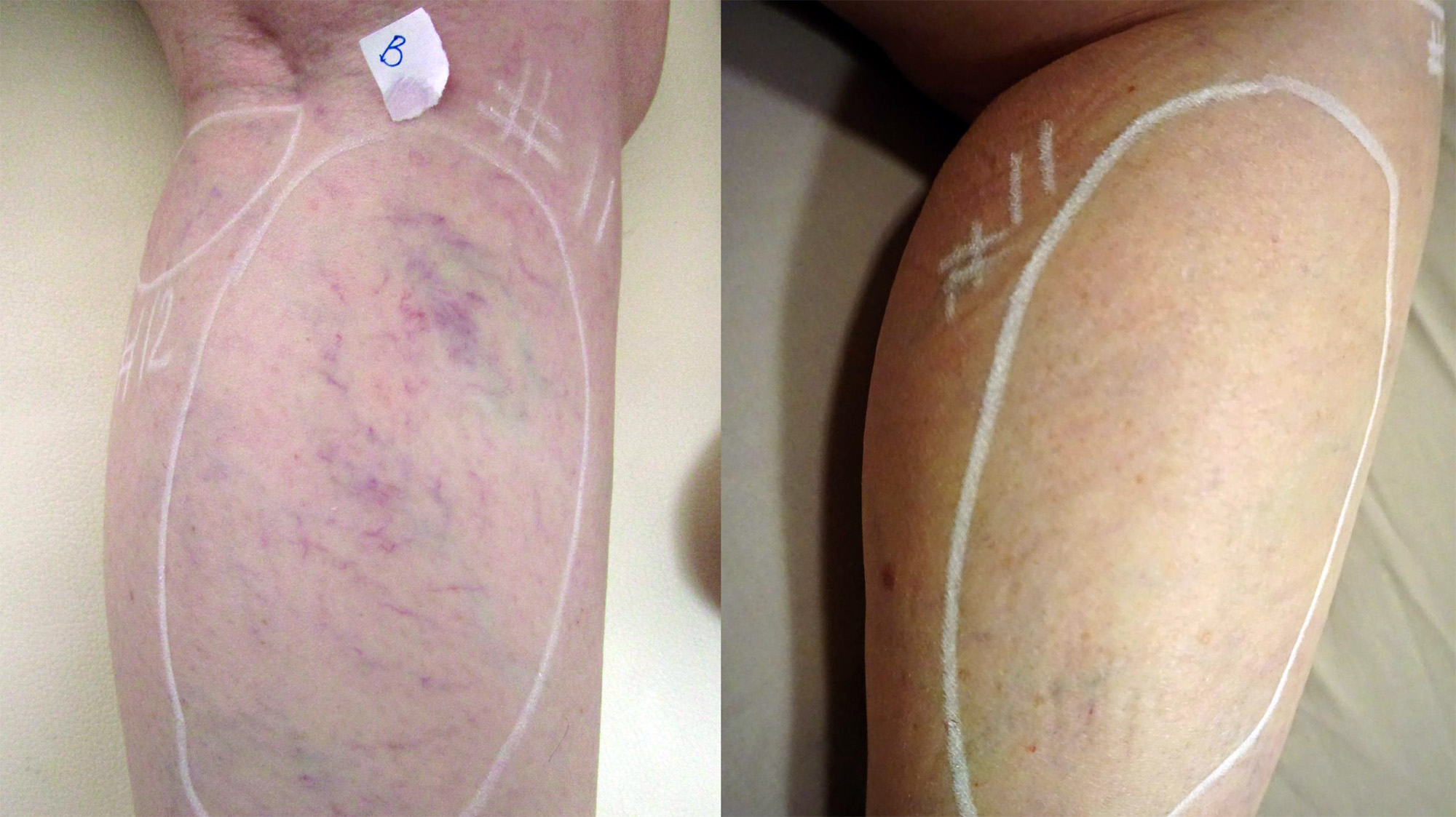 Vasculaze Before And After